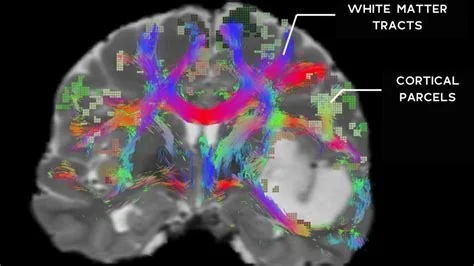 MIT Launches BrainStem Bundle Tool for White‑Matter Mapping